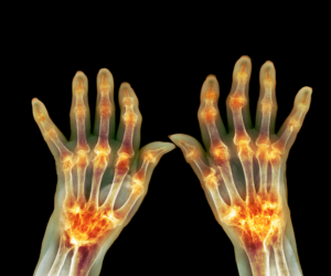 What is Arthritis? How to Relieve Arthritis Pains